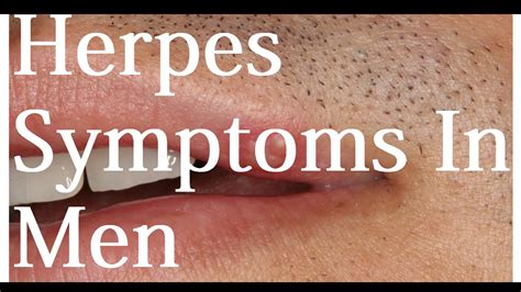 herpee|pictures of herpes in men.